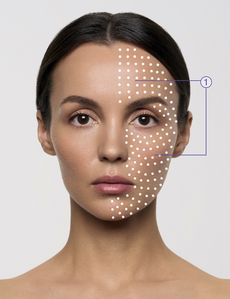 Micropapular Technique