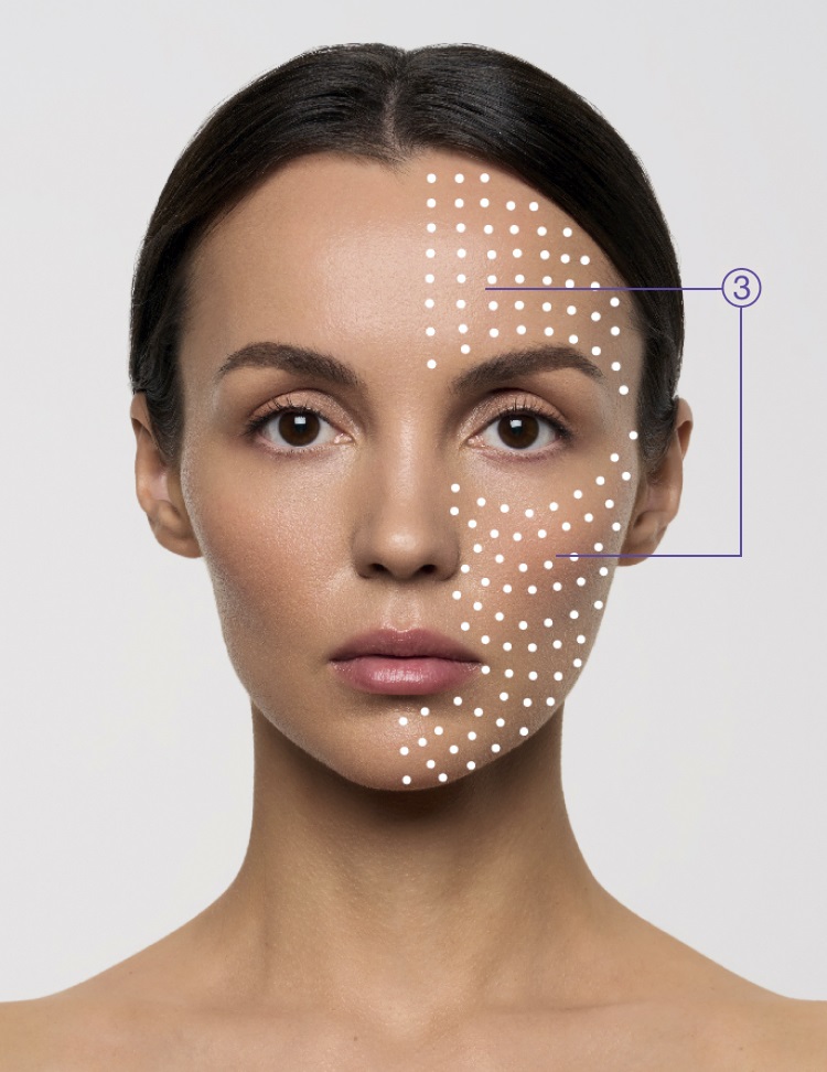 Micropapular Technique